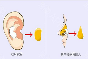 上海医院耳软骨垫鼻尖