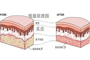上海吸脂减肥后，皮肤会变松弛吗?