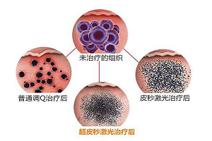 上海超皮秒激光祛斑怎么样？效果好吗？