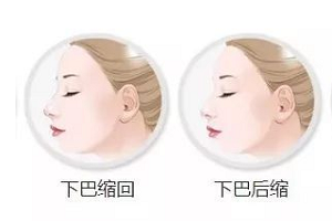 什么样的下巴好看?如何整下巴呢?