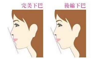 隆下巴手术好
