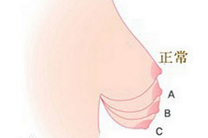 上海乳房下垂矫正好吗?效果明显吗?