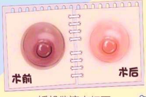 上海乳晕漂红