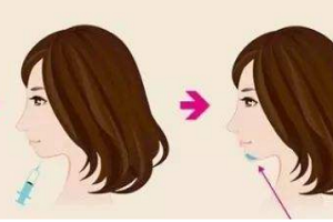 上海艺星隆下巴的方法有哪些?