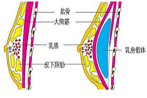 隆胸假体取出需要多久可恢复