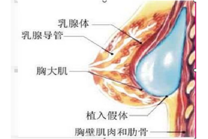 上海假体隆胸价格参考