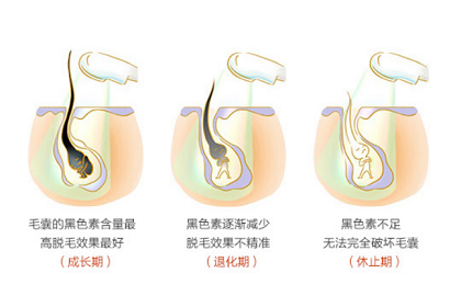 上海激光脱小腿毛有副作用吗?