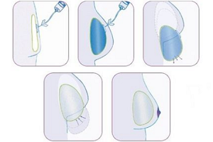 上海乳房再造术可重塑自信吗?