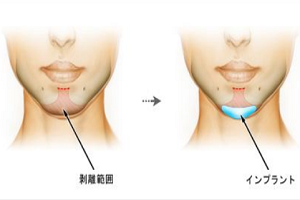 上海下巴假体取出后会发炎吗?