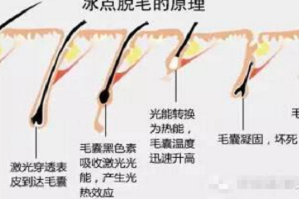 上海艺星激光脱毛可以吃辣吗?