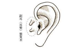上海副耳整形术后需要修复吗?