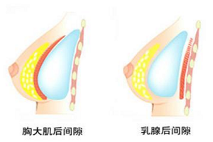 上海假体隆胸手术能保持多久?