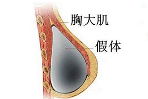 乳房再造术什么时候做合适?