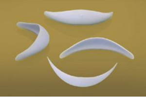 下巴假体取出后会肿胀吗?