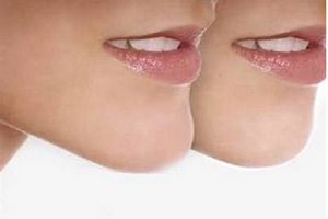 下巴假体取出后会肿胀吗?