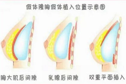 上海隆胸的方法有哪些?