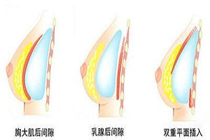 假体隆胸可以选择哪几种材料进行呢