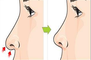 影响鼻翼缩小术恢复的因素有哪些