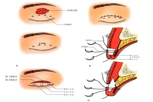 双眼皮手术后一定要注意这几点