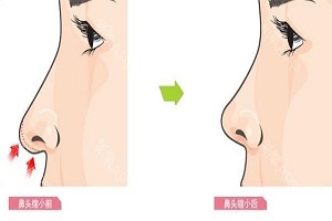 鼻综合手术的优势有哪些呢