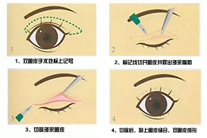 双眼皮手术后要注意哪些问题呢