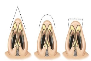 自体软骨隆鼻尖的效果怎么样