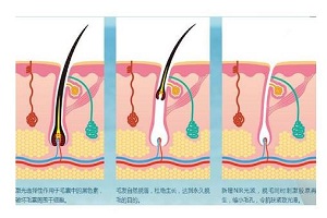 激光脱毛腿部的价格贵吗