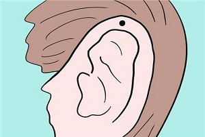 耳部畸形该怎么矫正呢
