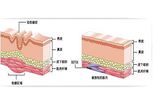 除皱价格是多少