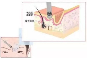 瘦脸都有哪些优缺点呢