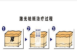 激光去除黄褐斑的优点有哪些