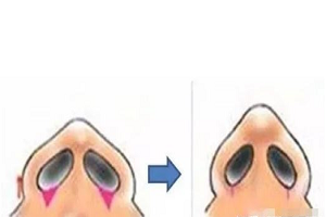 鼻翼宽整形美容的手术过程是怎样的
