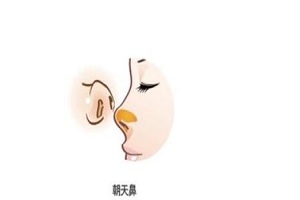 朝天鼻该怎么矫正呢