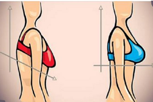 乳房下垂矫正手术怎么样