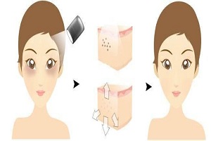 激光去黑眼圈的优势有哪几点