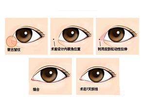 眼部整形都有着哪几种方法呢