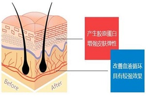 做面部线雕提升会不会很痛呢