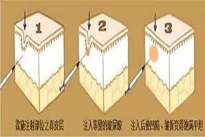 那种方法去除川字纹效果最好呢