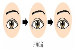 开眼角手术的各种疑问解答