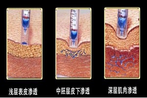 电波拉皮去抬头纹的效果能维持多久