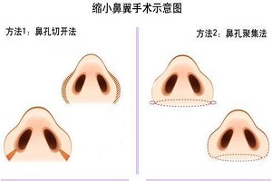 不同鼻型的鼻翼缩小方法