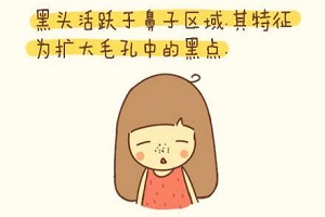 轻松去除黑头的小诀窍