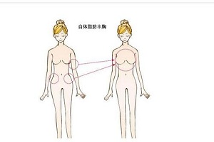 自体脂肪隆胸 隆胸减肥一举多得