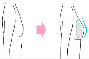 假体隆胸材料的保质期有多长