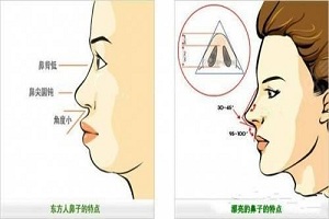 玻尿酸隆鼻一定要多注意这几点