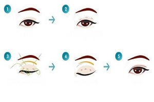 做完双眼皮手术后应注意哪些方面