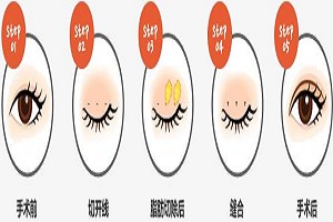 常见双眼皮手术方法有哪些