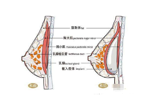 假体隆胸术后还会胸部下垂吗