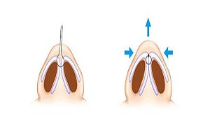鼻小柱延长手术的主要材料分为那几种呢