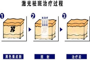 激光祛斑祛痣的适应症有哪些